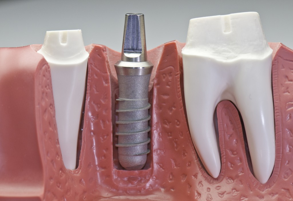 Pose implant dentaire (tout savoir sur l'implantologie)  Dr WeinmanDr  Jérôme Weinman chirurgien-dentiste Paris & médecin-dentiste Genève