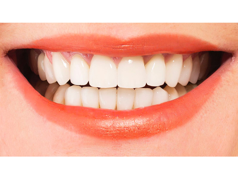 Améliorer votre sourire avec les facettes dentaires