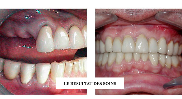 Pose de Bridges Dentaires Céramiques à Paris  Dr Jérôme WeinmanDr Jérôme  Weinman chirurgien-dentiste Paris & médecin-dentiste Genève