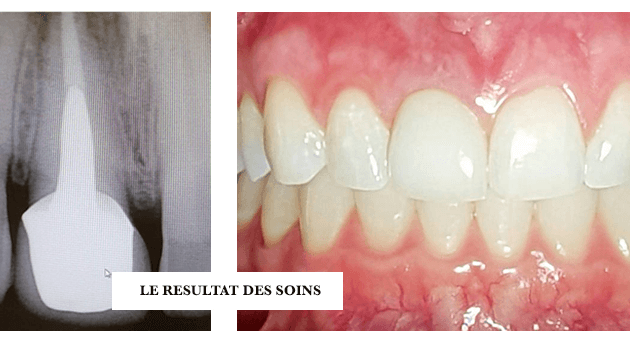 Couronnes dentaires - Soins dentaires - Dentiste D2L