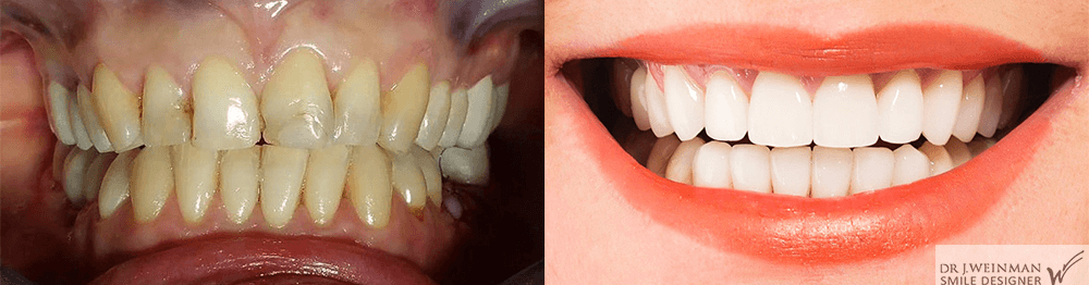 Les facettes dentaires