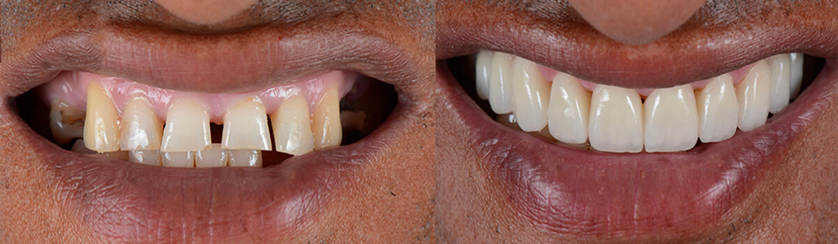 Dentier cosmétique Facettes en résine fausses dents blanc haut + bas